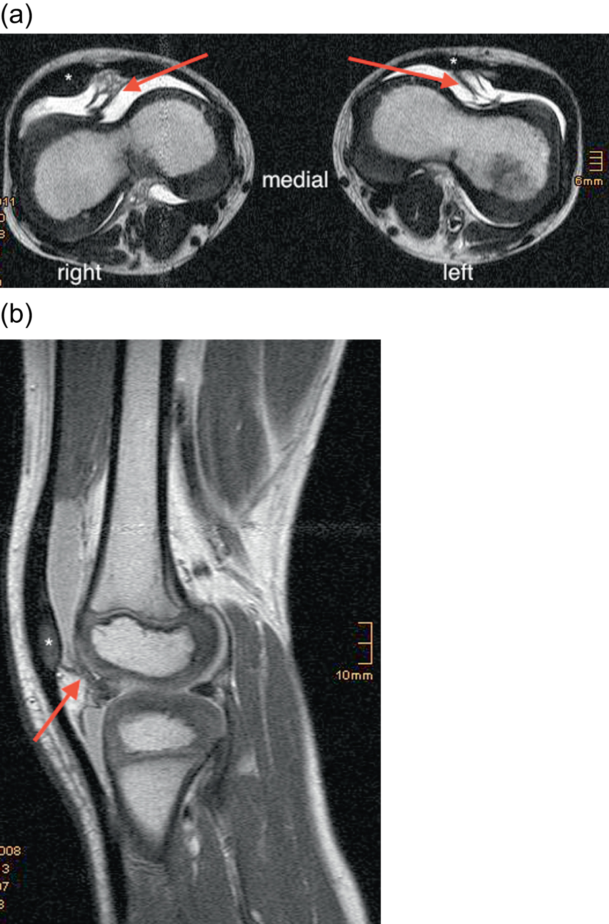 PDF) Nail-patella syndrome - Renal and musculo-skeletal features