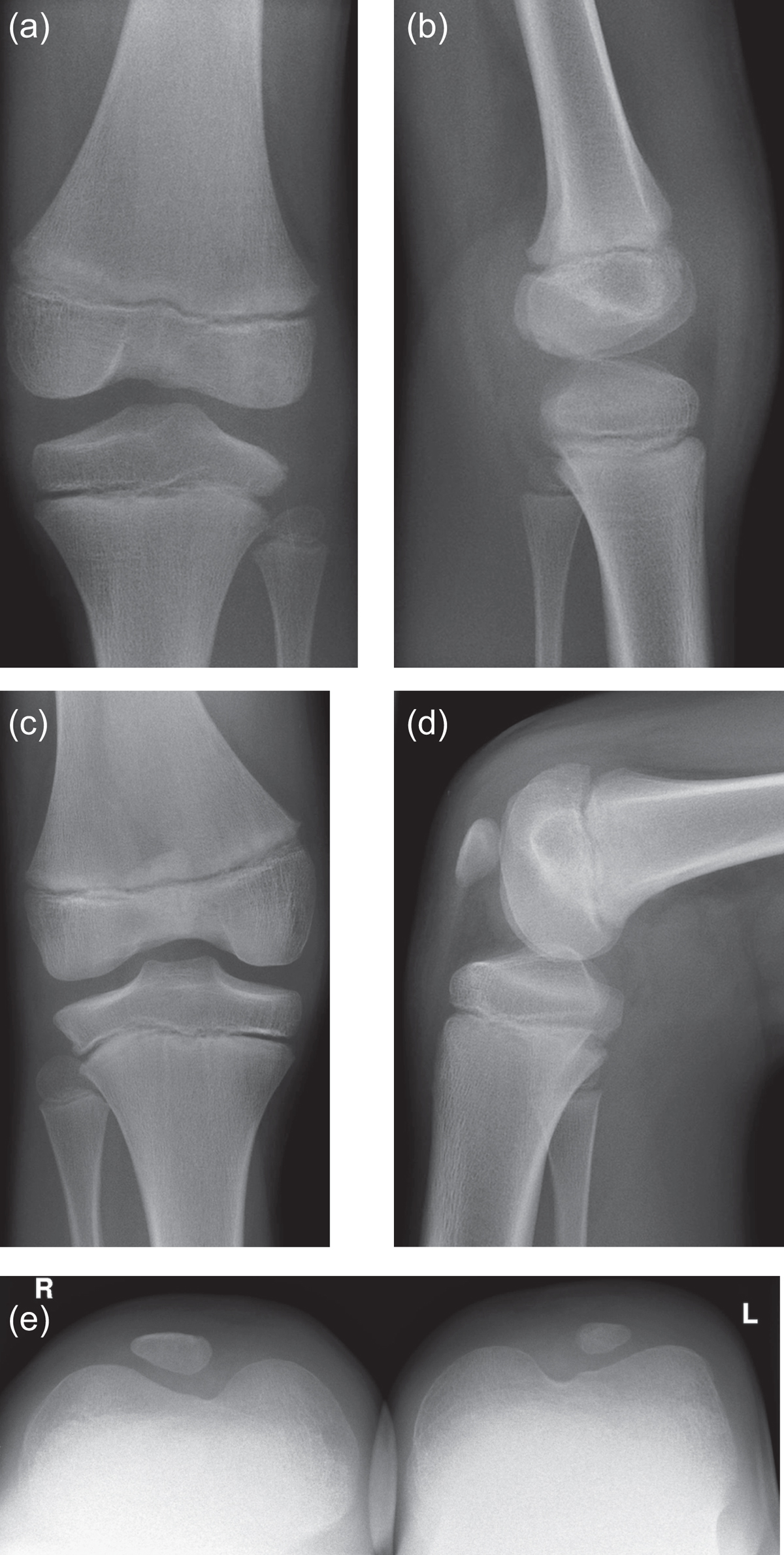 A hypoplastic patella fracture in nail patella syndrome: a case report |  Journal of Medical Case Reports | Full Text