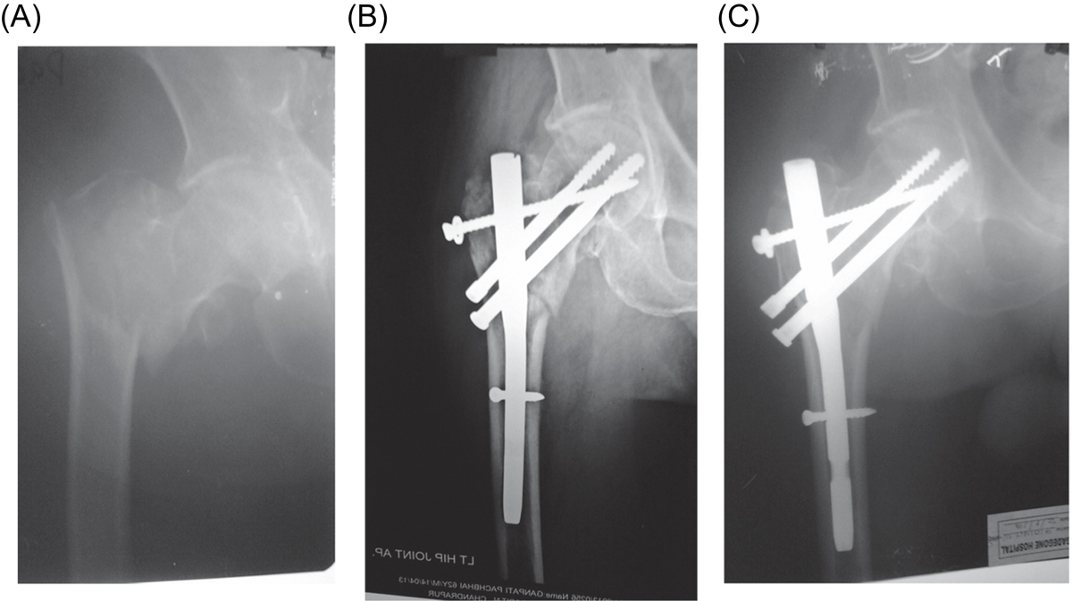 Can Tri-Max Proximal Femoral Nail System - Canwell Medical