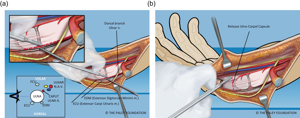 The Paley ulnarization of the carpus with ulnar shortening osteotomy for  treatment of radial club hand | SICOT-J