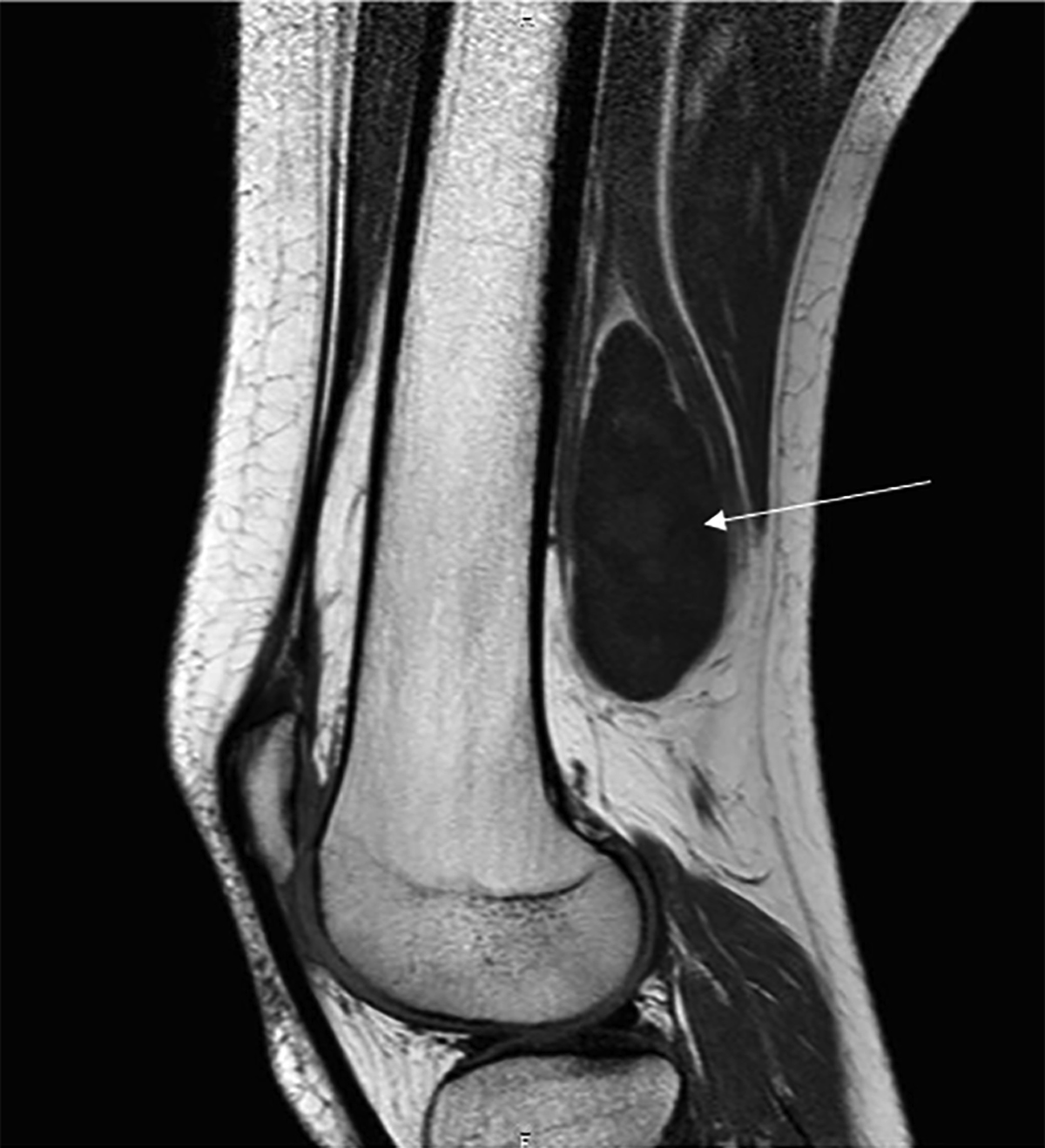 A Rare Cause Of Sciatica Sciatic Nerve Schwannoma Report Of One Case